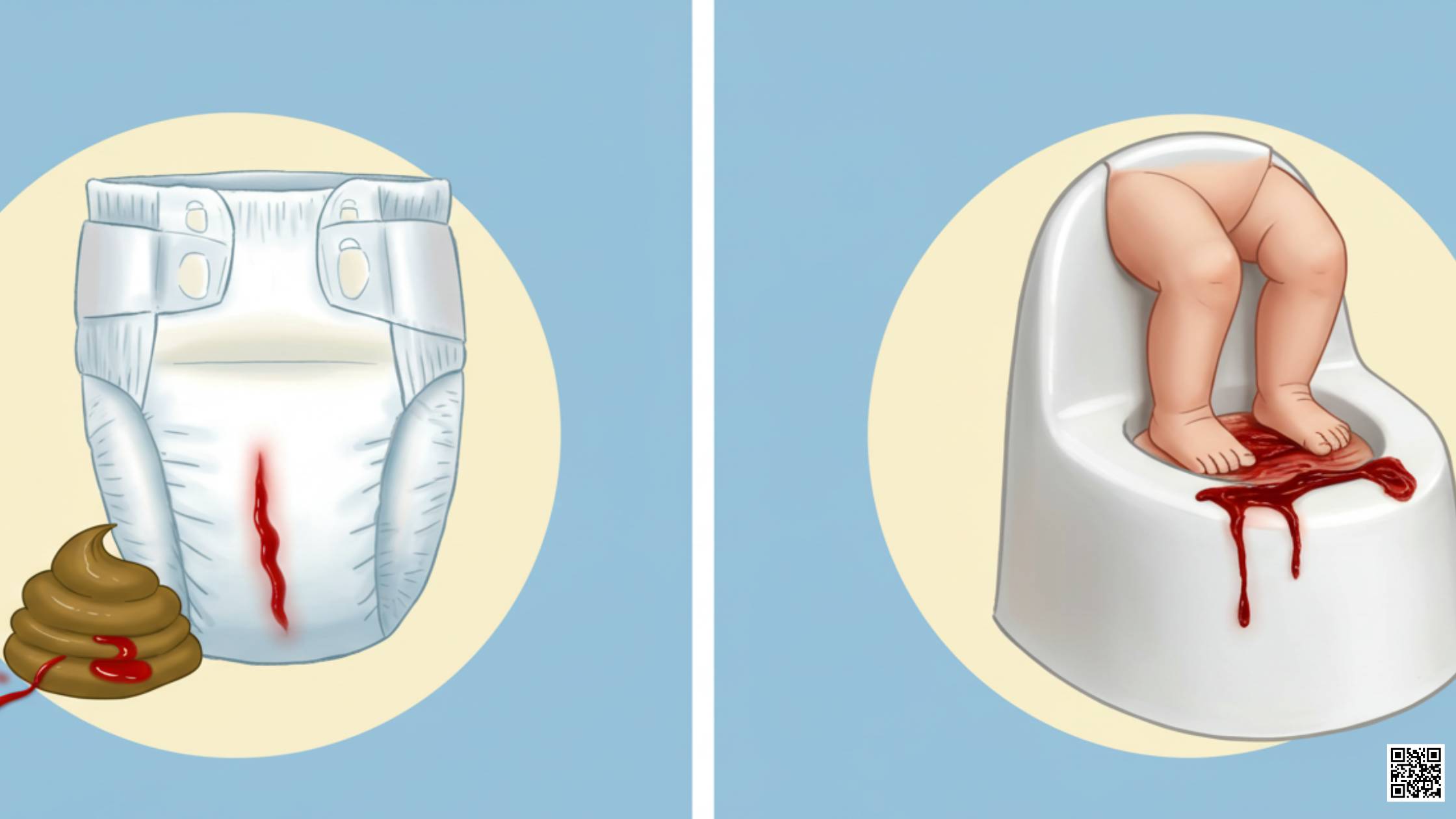 Blood in Baby’s Stool What Parents Need to Know
