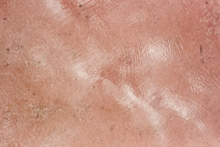 A Simple Guide to Healthy Skin and Preventing Future Flare-Ups